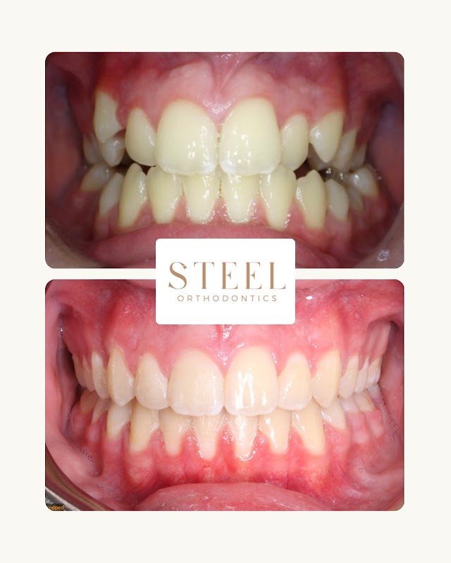 Steel Orthodontics